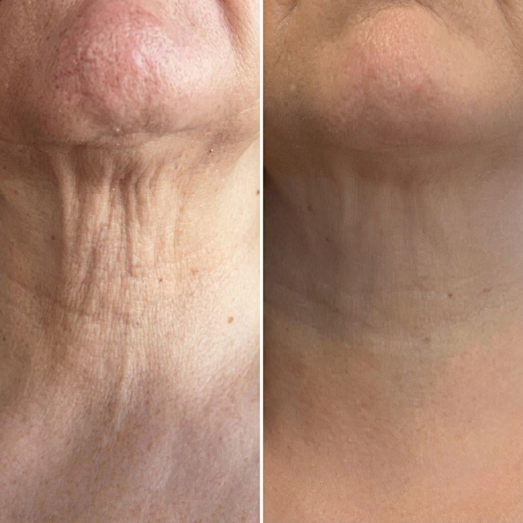 MASAJEADOR/Antiarrugas Rodillo 3D Integrado - Específico para cuello y rostro \ TVLV
