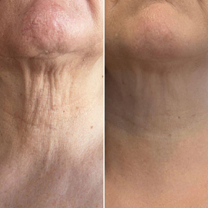 MASAJEADOR/Antiarrugas Rodillo 3D Integrado - Específico para cuello y rostro \ TVLV